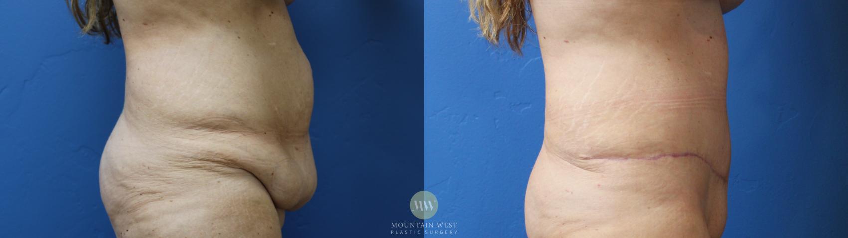 Before & After Tummy Tuck Case 153 Right Side View in Kalispell, MT