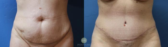 Before & After Tummy Tuck Case 161 Front View in Kalispell, MT
