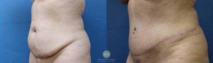 Before & After Tummy Tuck Case 161 Left Oblique View in Kalispell, MT