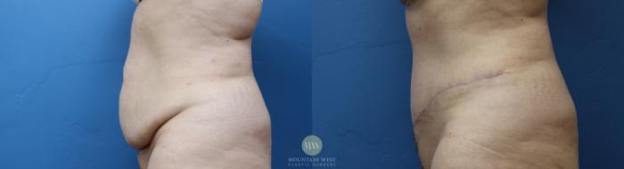 Before & After Abdominoplasty Case 161 Left Side View in Kalispell, MT