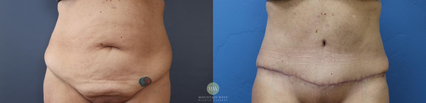 Before & After Tummy Tuck Case 165 Front View in Kalispell, MT