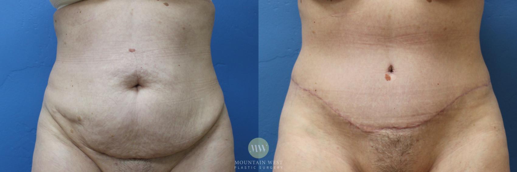 Before & After Tummy Tuck Case 175 Front View in Kalispell, MT