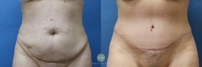 Before & After Body contouring after weight loss Case 175 Front View in Kalispell, MT