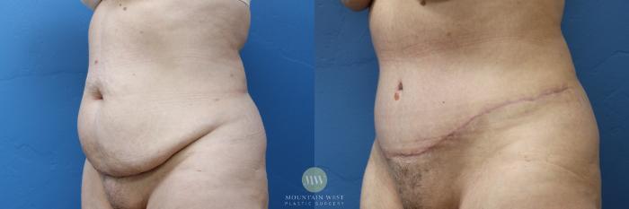 Before & After Tummy Tuck Case 175 Left Oblique View in Kalispell, MT