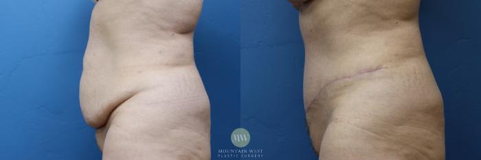 Before & After Tummy Tuck Case 175 Left Side View in Kalispell, MT