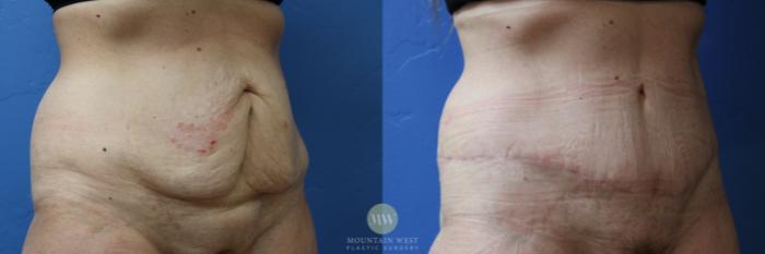 Before & After Tummy Tuck Case 192 Right Oblique View in Kalispell, MT