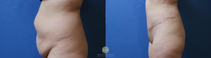 Before & After Tummy Tuck Case 194 Left Side View in Kalispell, MT