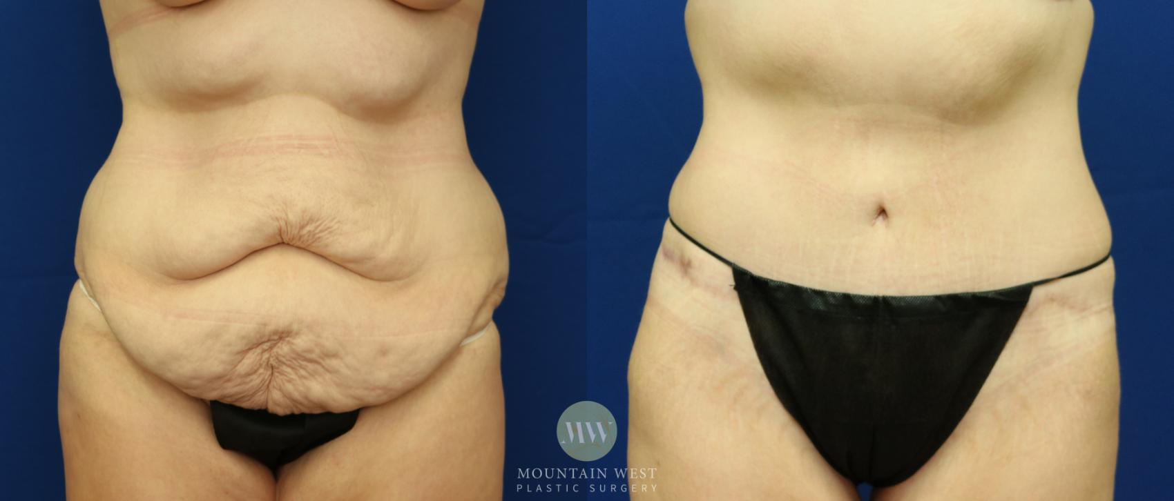 Before & After Tummy Tuck Case 34 View #1 View in Kalispell, MT