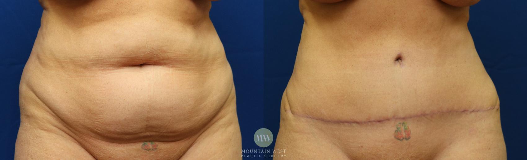 Tummy Tuck Case 56 Before & After View #1 | Kalispell, MT | Mountain West Plastic Surgery