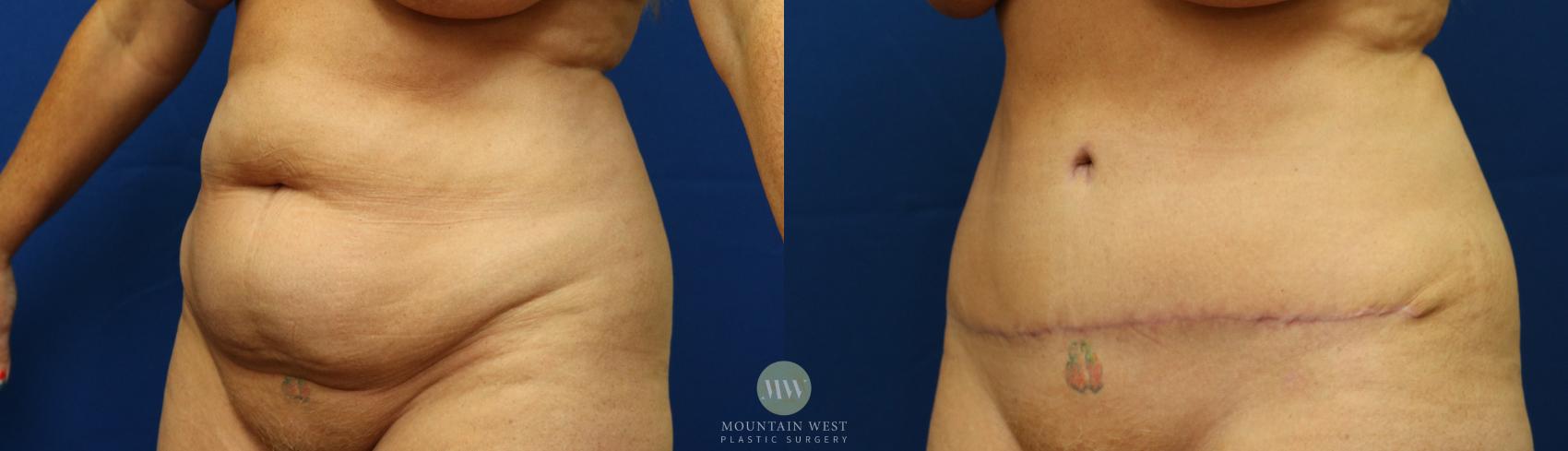 Tummy Tuck Case 56 Before & After View #2 | Kalispell, MT | Mountain West Plastic Surgery