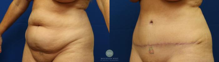 Before & After Tummy Tuck Case 56 View #2 View in Kalispell, MT