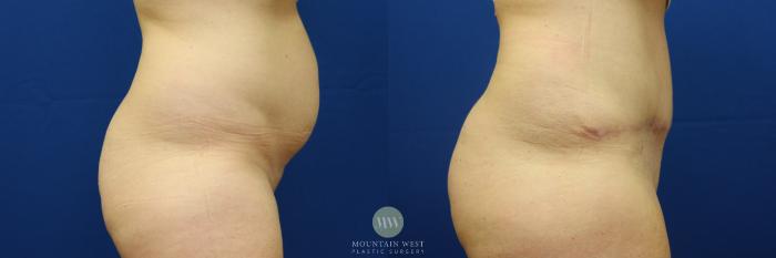 Before & After Tummy Tuck Case 82 View #1 View in Kalispell, MT