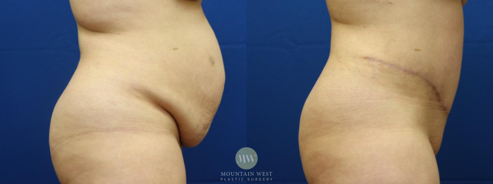 Before & After Tummy Tuck Case 91 View #1 View in Kalispell, MT