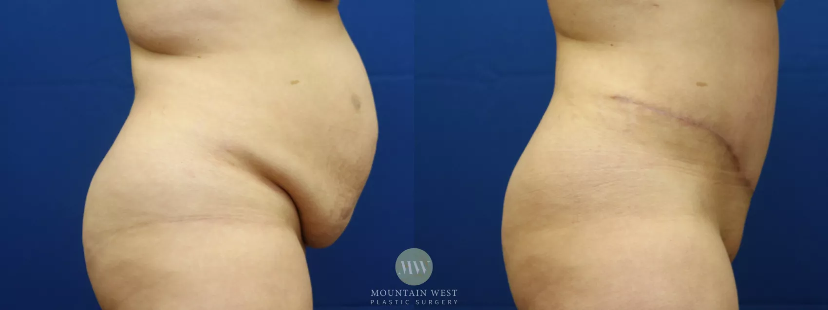 Breast Reduction Before and After Pictures Case 70, Kalispell, MT