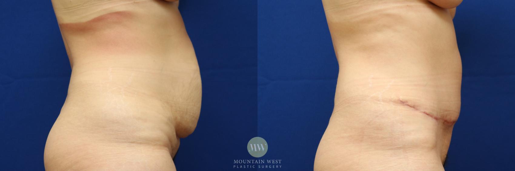 Tummy Tuck Case 98 Before & After Right Side | Kalispell, MT | Mountain West Plastic Surgery