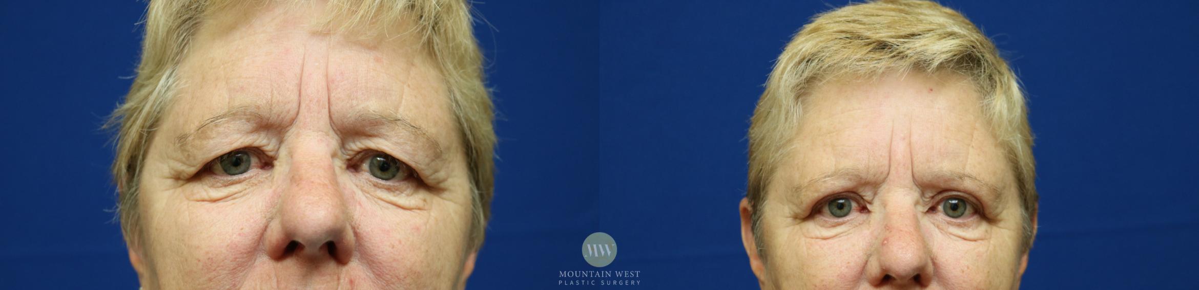 Upper Blepharoplasty Case 133 Before & After Front | Kalispell, MT | Mountain West Plastic Surgery