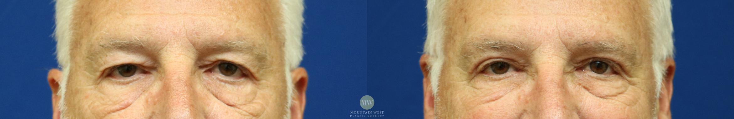 Before & After Upper Blepharoplasty Case 60 View #1 View in Kalispell, MT